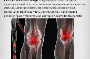 Синдром Рейтера в колене