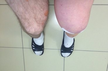 Колено после операции