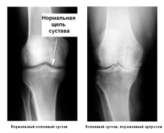 Снимок сустава пораженного болезнью