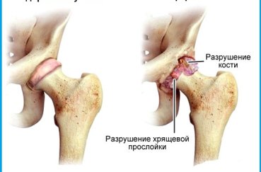 Сравнение здорового и больного артритом сустава