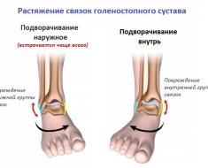 Способы как можно подвернуть ногу