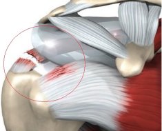 Видимый разрыв сухожилий