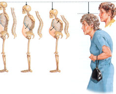 Изменение скелета человека