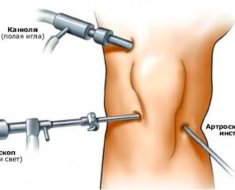 Процесс артроскопии