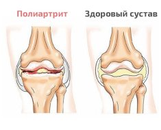 Сравнение больного и нормального сустава