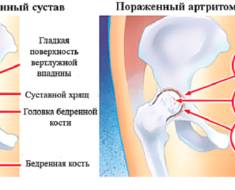 Тазобедренный сустав