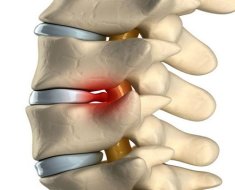 Межпозвоночная грыжа