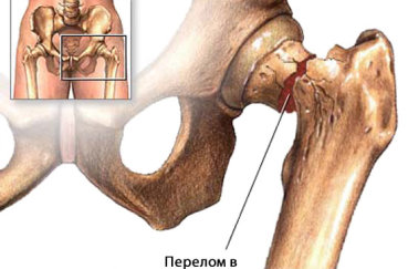 Перелом тазобедренного сочленения