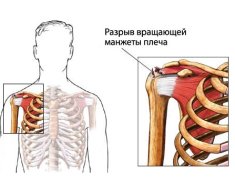 Разрыв вращательной манжеты