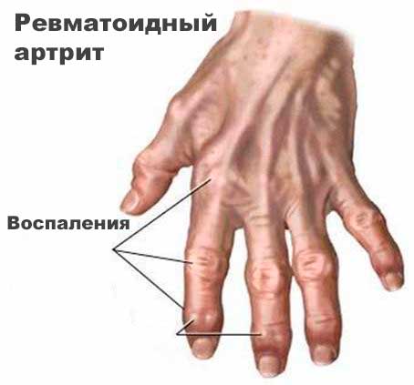 Серонегативный ревматоидный артрит