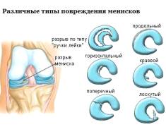 Различные типы повреждения
