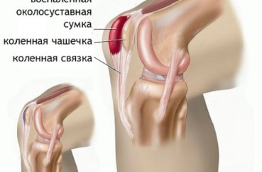 Бурсит коленного сустава