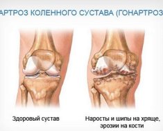 Наросты и шипы на хряще