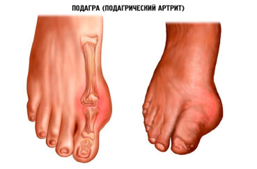 Подагрический артрит