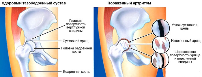 Ревматоидный артрит