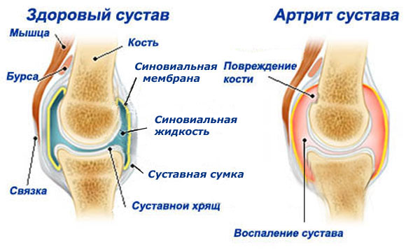 Боль в колене при ходьбе из-за артрита