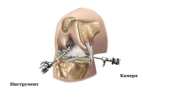 Пластика ПКС - артроскопия Пластика передней крестообразной связки