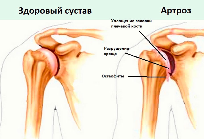 Ноет плечевой сустав при артрозе