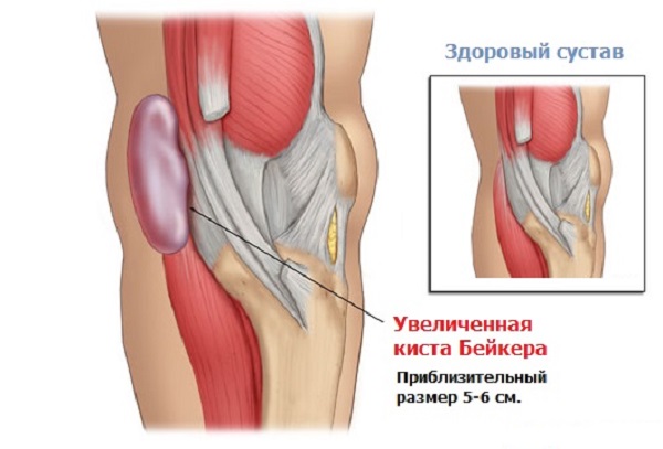 Киста Бейкера коленного сустава