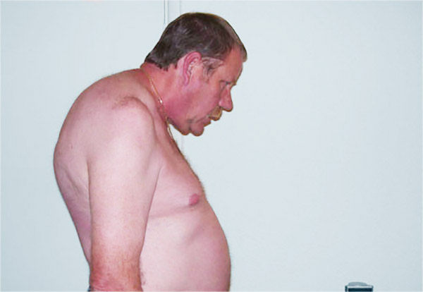 Причины анкилозирующего спондилоартрита Анкилозирующий спондилоартрит