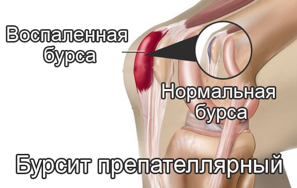 Супрапателлярный бурсит коленного сустава