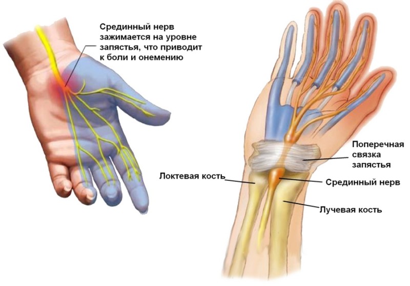 Симптомы туннельного синдрома запястья