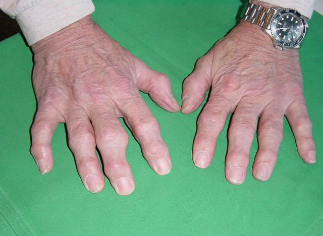 Особенности полиартрита Полиартрит