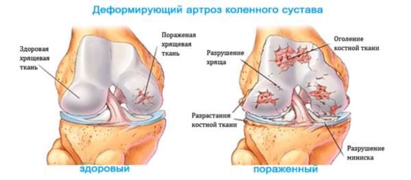 Деформирующий артроз
