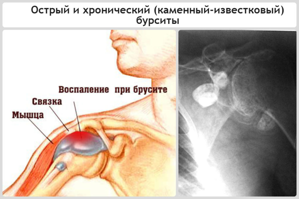 Суставная сумка