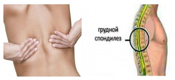 Спондилез позвоночника