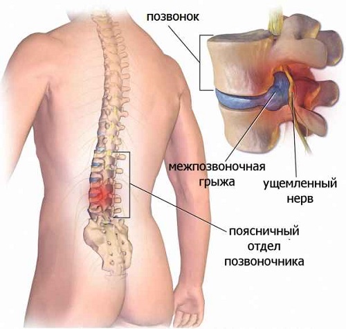 Лечить грыжу позвоночника