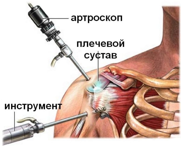 Надрыв связок плечевого сустава