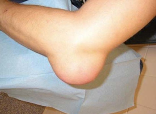 Шишка на локтевом суставе при онкологии Шишка на локте при онкологии