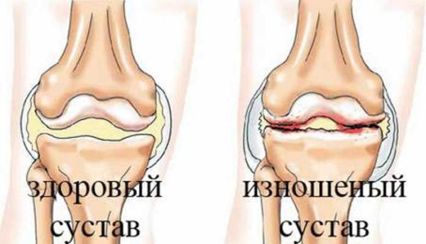 Двусторонний гонартроз