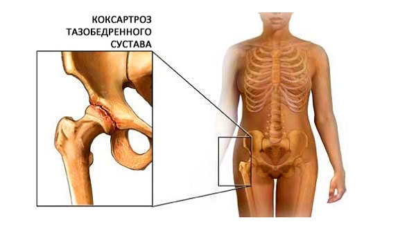 Лечение коксартроза