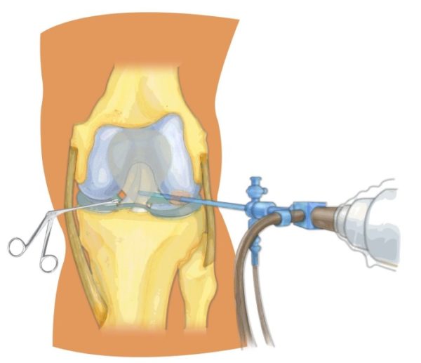 Процесс артроскопии мениска Процесс резекции мениска