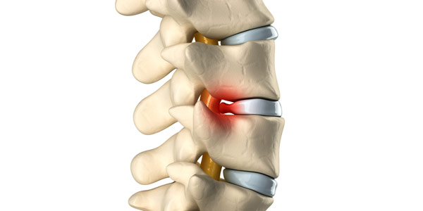 Компрессионный перелом позвоночника у детей: особенности Компрессионный перелом позвоночника у детей