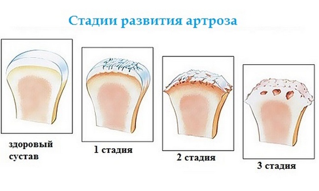 Деформирующий артроз