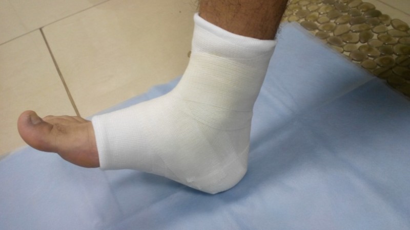 Неподвижность ноги при растяжении связок голеностопа Растяжение связок голеностопа