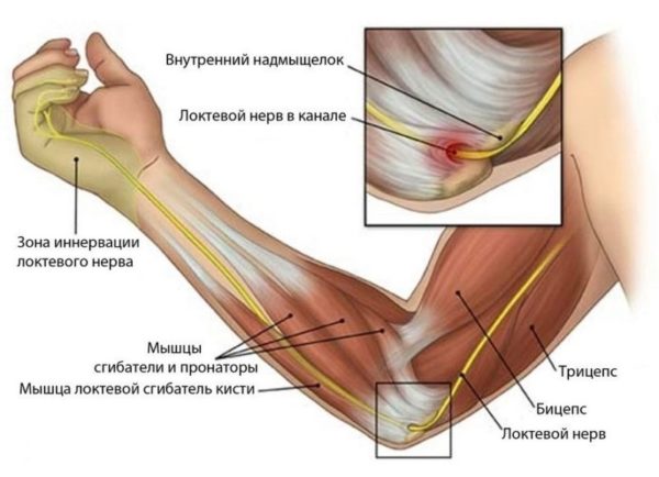 Боль в локте при неврите