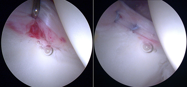 Артроскопия коленного сустава: ход операции Артроскопия коленного сустава