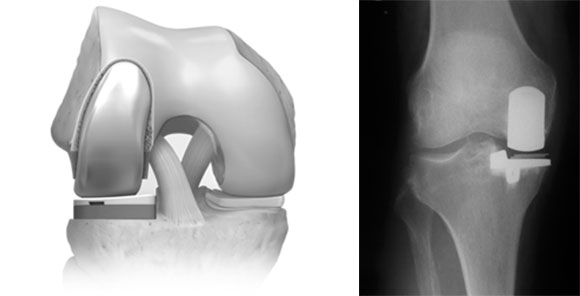 Виды операций по замене коленного сустава Операция по замене коленного сустава