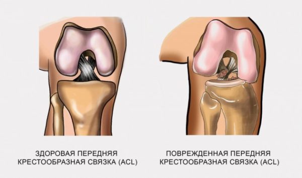 Связочный аппарат коленного сустава
