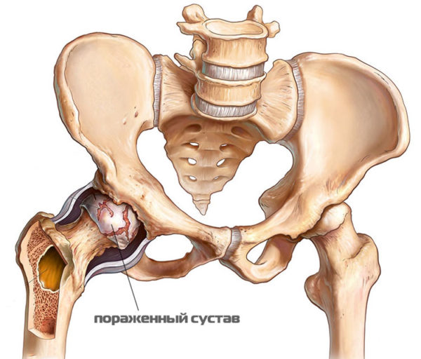 Виды перелома тазобедренного сустава Перелом тазобедренного сустава