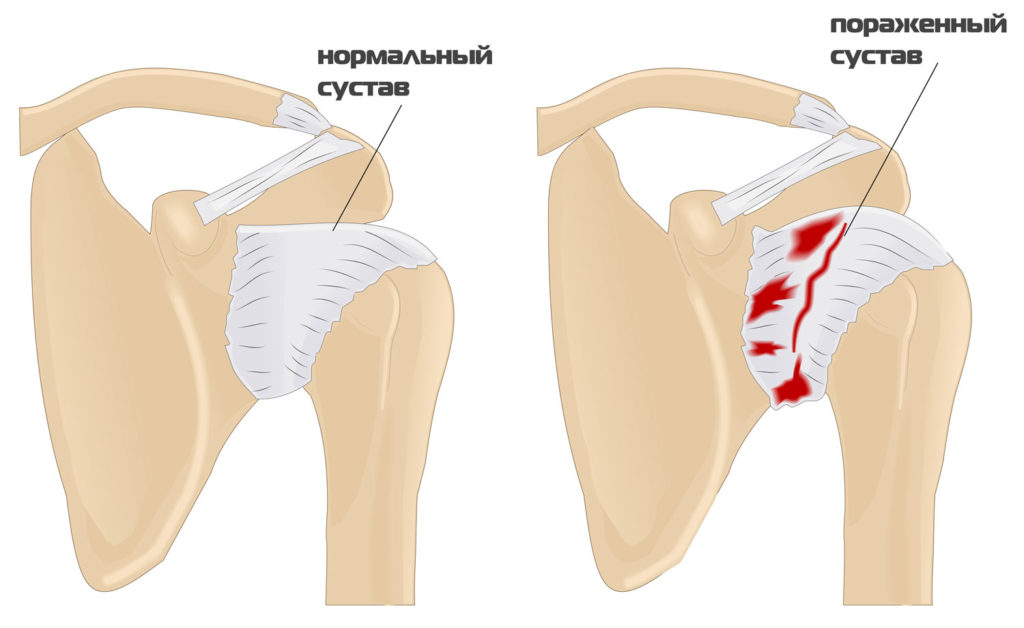 Как лечить периартрит