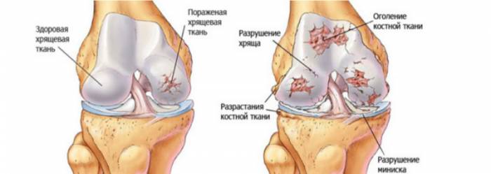 Гонартроз коленного сустава