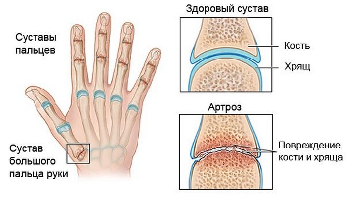 Артроз кистей