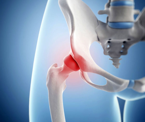 Причины возникновения бурсита тазобедренного сустава Бурсит тазобедренного сустава