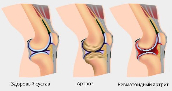 Артрит коленного сустава