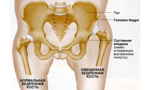 Дисплазия тазобедренного сустава у взрослых